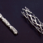 stent
