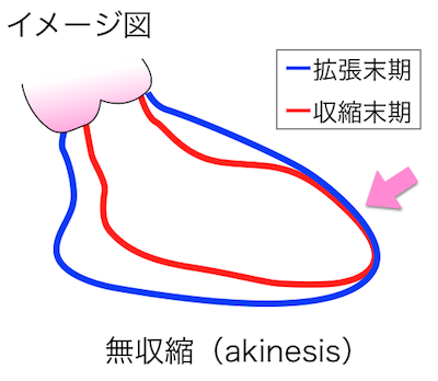 無収縮（akinesis）