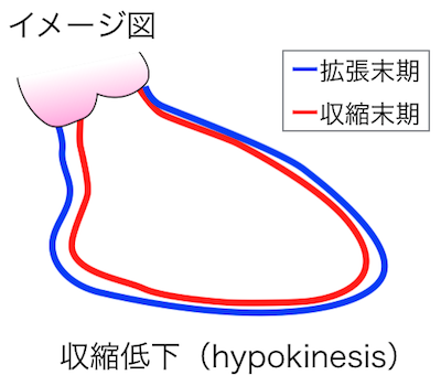 収縮低下（hypokinesis）