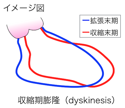 収縮期膨隆（dyskinesis）