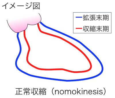 正常収縮（nomokinesis）