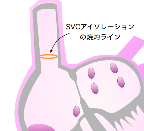 上大静脈隔離術　SVC Isolation